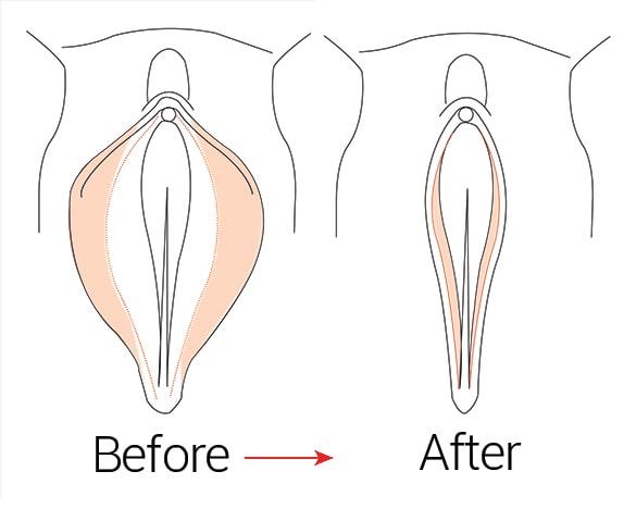 pussy before and after Old Vaginoplasty - BeingMom